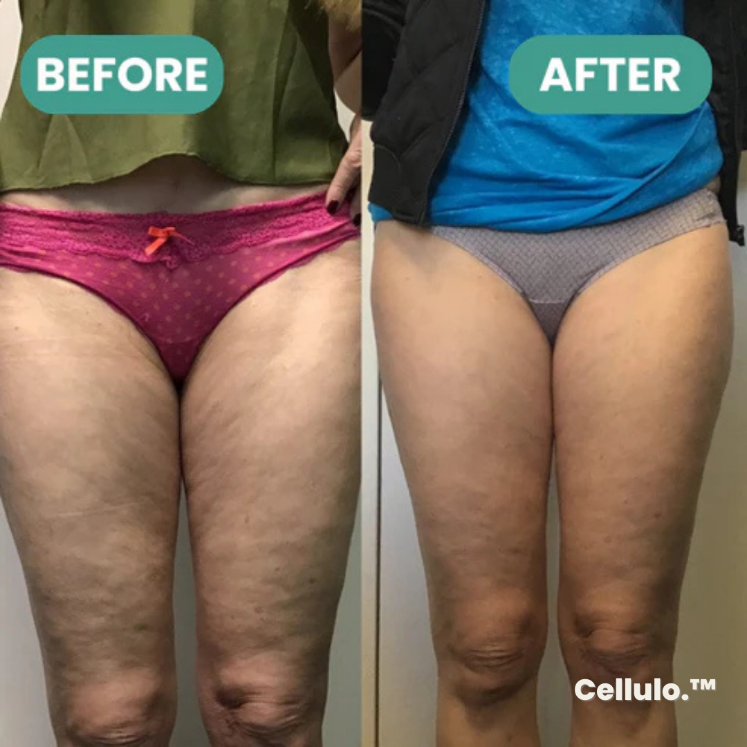 Cellulo.™ Anti-Cellulite Massager